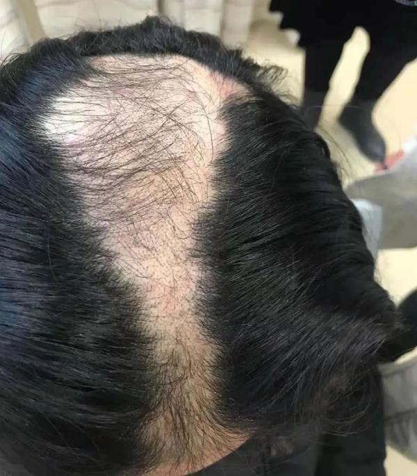 “10后”也禿了？小學女生不斷脫發，查出真相后，父母后悔不已